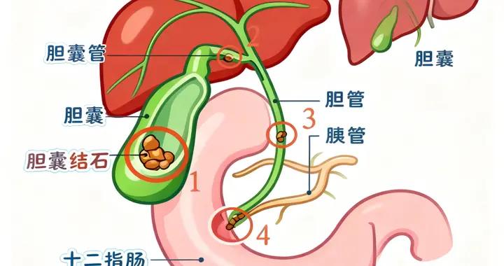 長期不喫早飯，真的會得膽結石嗎？