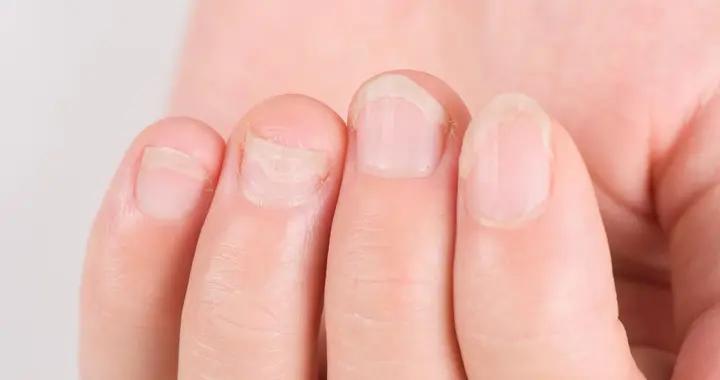 別忽視指甲豎紋！生理性vs病理性一眼分清，日常護理3招就夠了