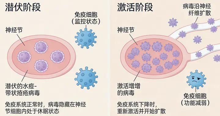 得過“纏腰龍”並非一勞永逸，這類人複發率最高達18%