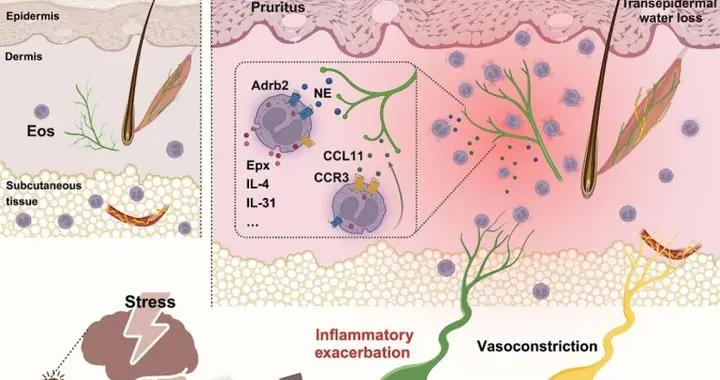 失眠、焦慮都會皮膚留痕 復旦團隊揭示心理應激如何加劇皮膚炎症
