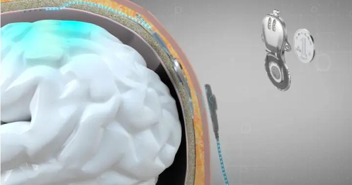 腦機接口進入臨牀應用 助患者實現腦控抓握“想動就動”