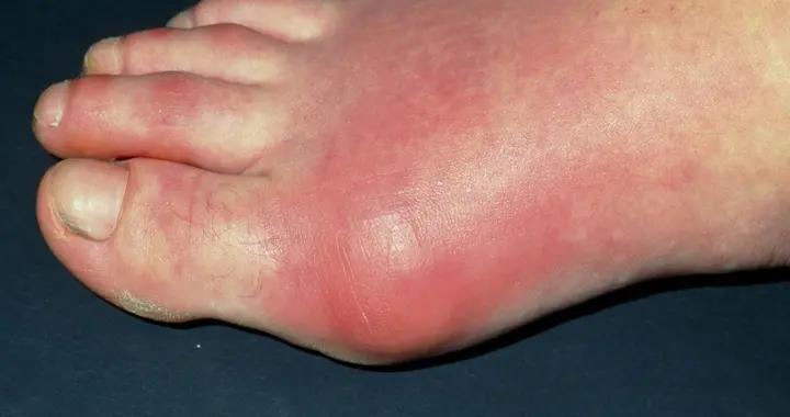 嘌呤不是敵人，但過量就“有毒”！5分鐘瞭解其危害與控制