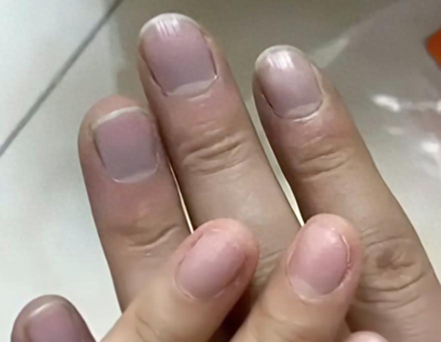 女子發現老公手指甲發紫，勸他去醫院被懟“喫飽了沒事幹”，幾天後老公突然胸痛被120拉走……醫生提醒