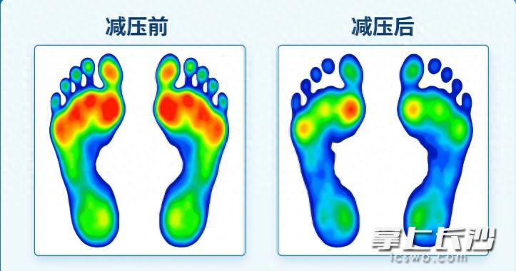 33歲“糖友”腳底反覆潰爛，醫生說非單純“糖尿病足”