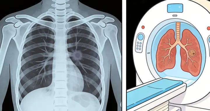 每年體檢正常，爲何肺癌一發現就是晚期？