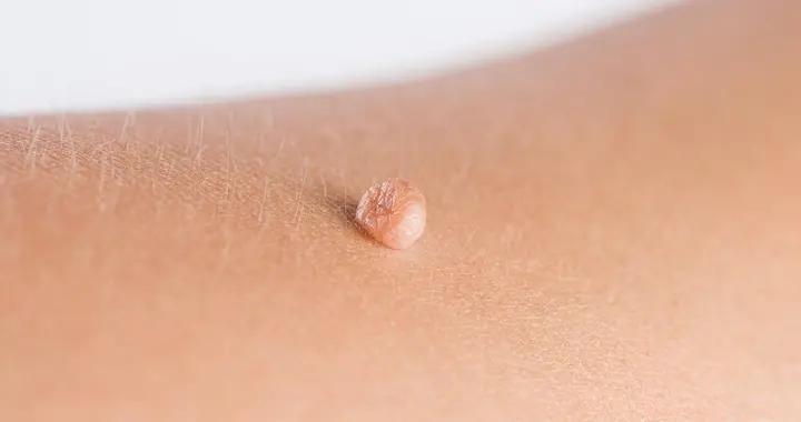 莫名長肉粒是咋回事？可能是軟纖維瘤或疣，鑑別要點看這裏