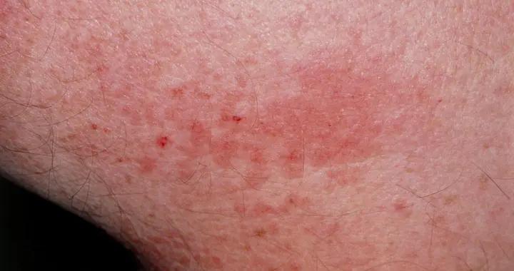 起過敏疙瘩別亂喫東西！這幾類食物不要喫，加速皮膚恢復