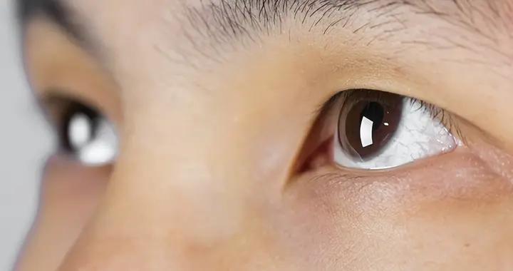 黑眼圈總消不掉？原來是這3種類型沒分清，對症改善才有效