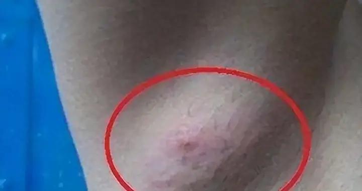 28歲女子洗澡發現腋窩腫塊，懷疑艾滋，醫生見手指受傷：病因明瞭