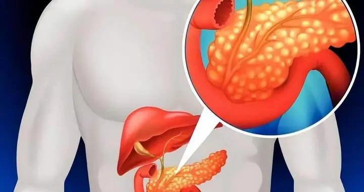 四川一64歲大爺查出胰腺癌，回家喝酒打麻將：咋地，癌症與我何干