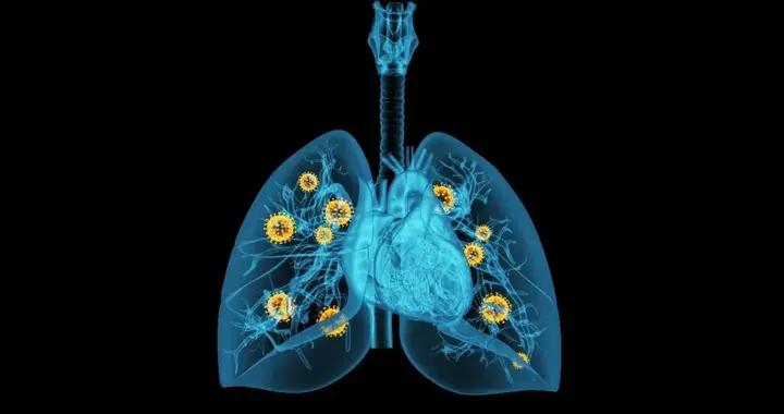 首款針對肺癌的吸入式基因療法進入快速審批通道