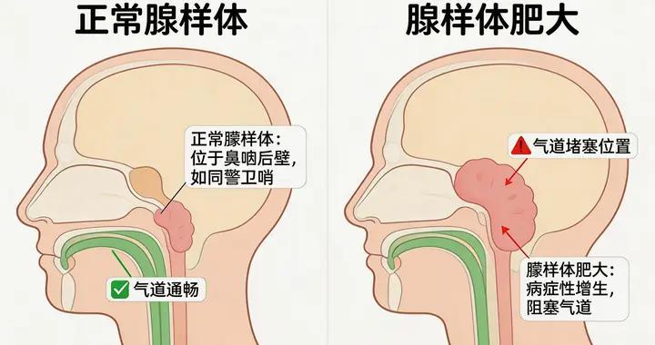孩子腺樣體肥大要不要做手術？