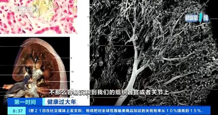 痛風急性發作期如何正確應對？聽聽專家怎麼說→